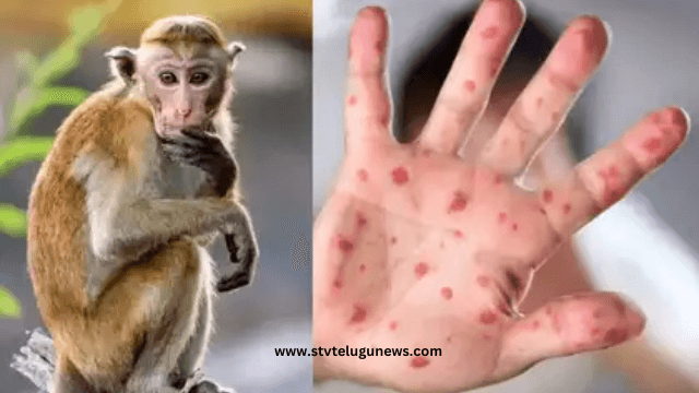 monkeypox virus is an orthopoxvirus that causes mpox